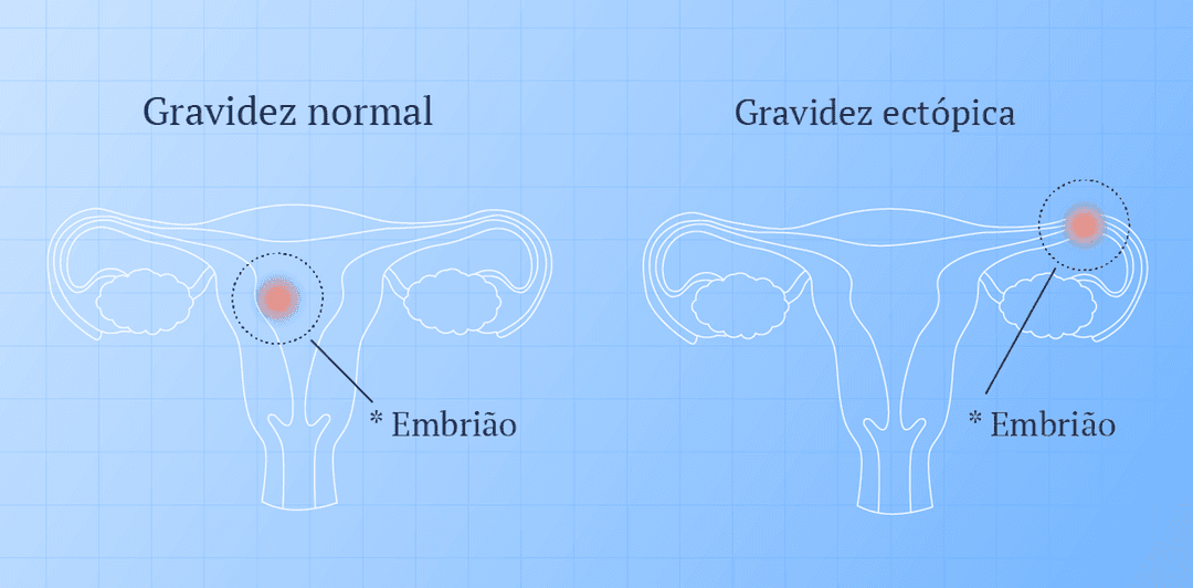 Ilustração de uma gravidez regular e uma gravidez ectópica.